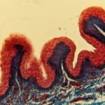 Hautkrebs Screening